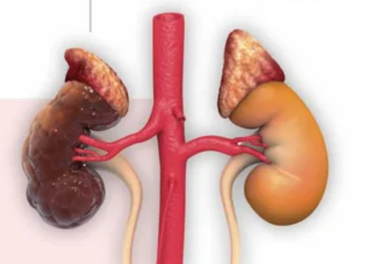 Kidney Rescue Herbal Supplements