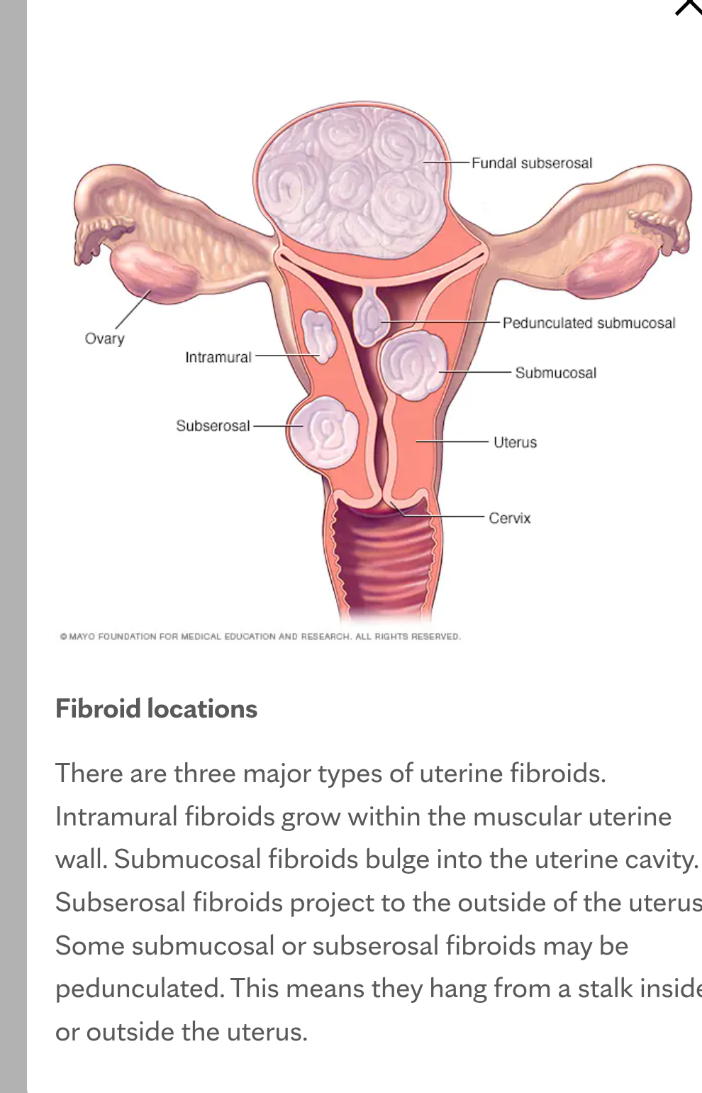 Fibroids Herbal Supplements