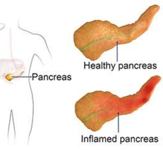 Pancreas Detox